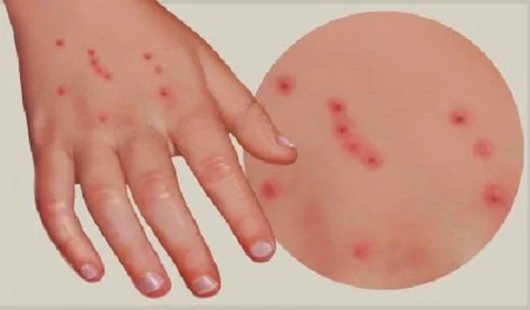 Хвороба Лайма – проблема сучасності та бомба уповільненої дії