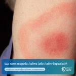 Що таке хвороба Лайма (або Лайм-бореліоз)?